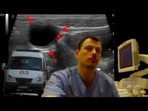 Pediatric Urinary tract sonography - bladder diverticulum