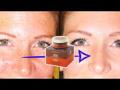 6 Best Creams To Get Rid Of FRECKLES/Pigmenation (Jhai)