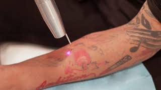Laser Tattoo Removal Procedure & Benefits
