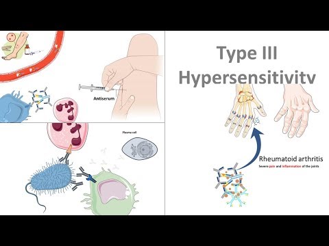 Type III hypersensitivity