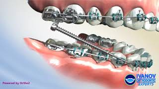 Forsus Appliance Fitting and Use