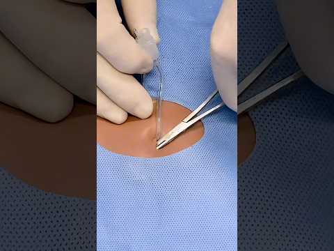 Loop Technique of Abscess Drainage 😷🤓 #goodtoknow #surgeonlife #abscess #vet #medicine #funfacts