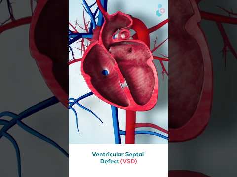 Ventricular Septal Defect Surgery ↪ 3D Medical Animation #Shorts #VSD #VentricularSeptalDefect