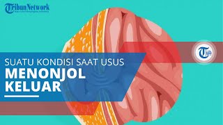 Hernia Umbilikalis, Kondisi ketika Terdapat Bagian Usus yang Menonjol Keluar dari Pusar
