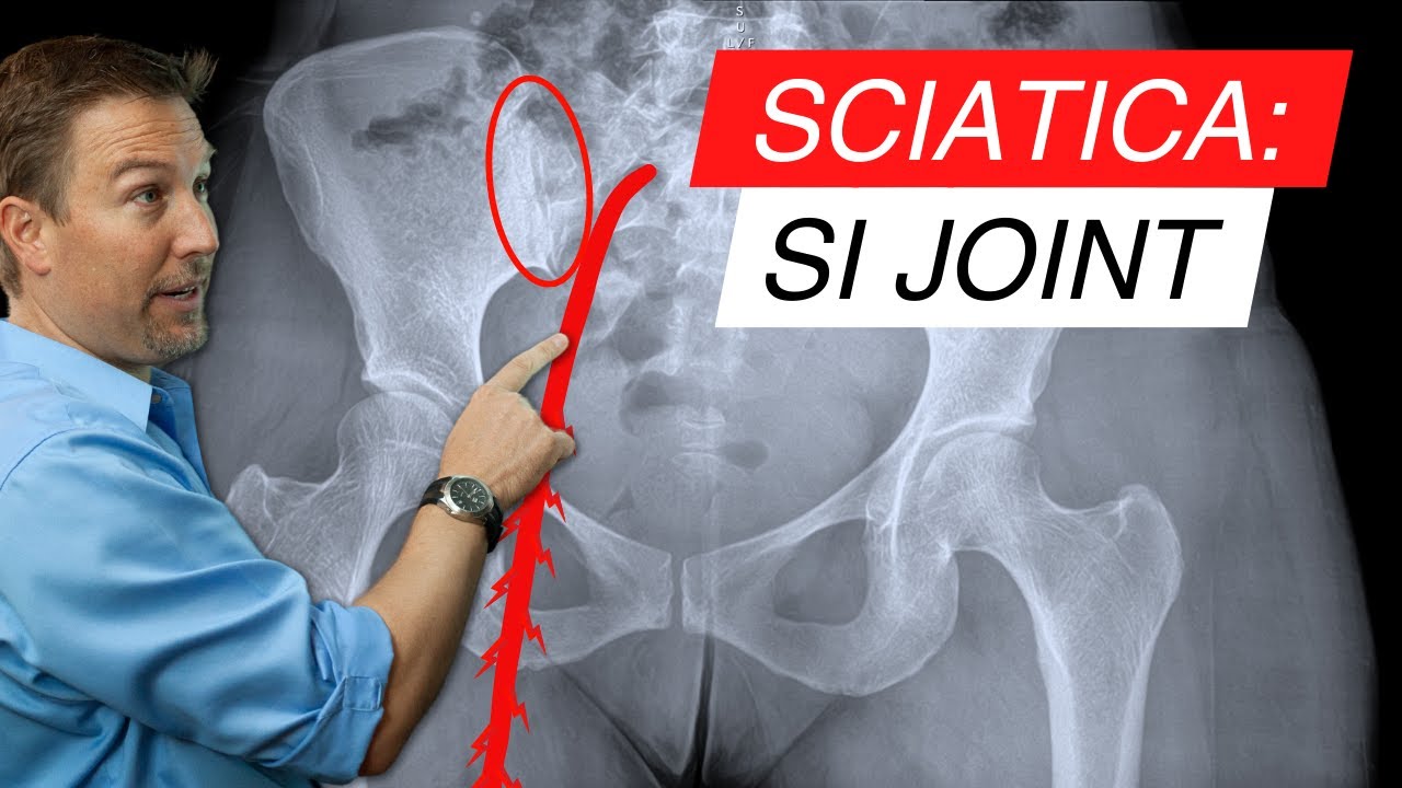 Sciatica and SI Joint Dysfunction: The Surprising Connection