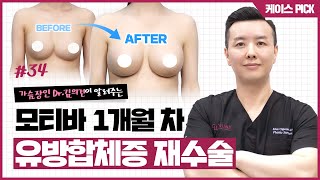 유방합체증과 밑빠짐 부작용으로 모티바 보형물을 이용해 재수술한 케이스!