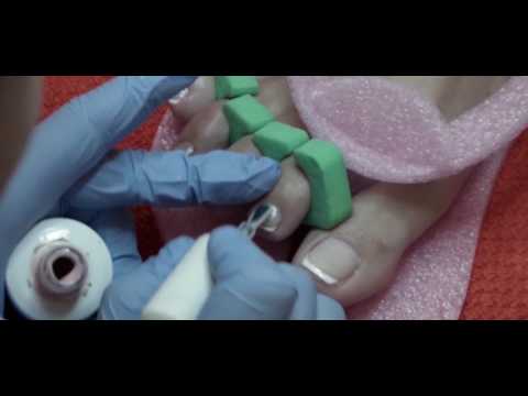 Kuko halamang-singaw paggamot manicure tools Paa halamang-singaw sa mga bata ginagamot tao