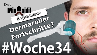 Das Minoxidil Experiment #Woche34 Dermaroller Fortschitte?