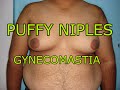 Gynecomastia Maleboobs Gynecomastia Male Boobs Puffy Niples In Young Man