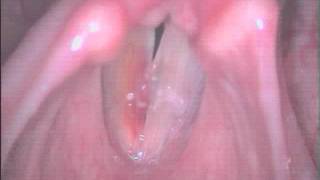 8 - Right vocal fold polyp - pre - ROVD