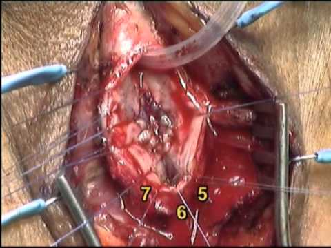 Buccal Mucosa Graft - Bulbar Urethral Reconstruction