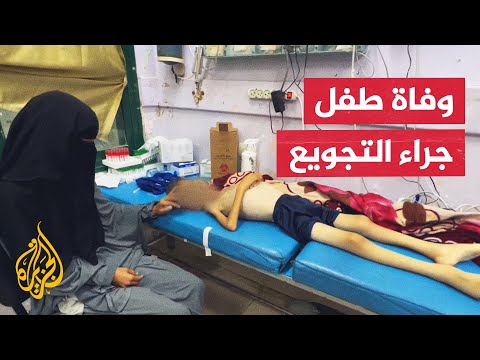 فيديو | ارتفاع حصيلة وفيات سوء التغذية في غزة إلى 440 شهيدا بينهم 147 طفلا