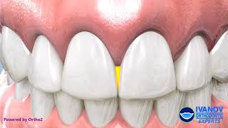 Interproximal Reduction for Dark Triangles