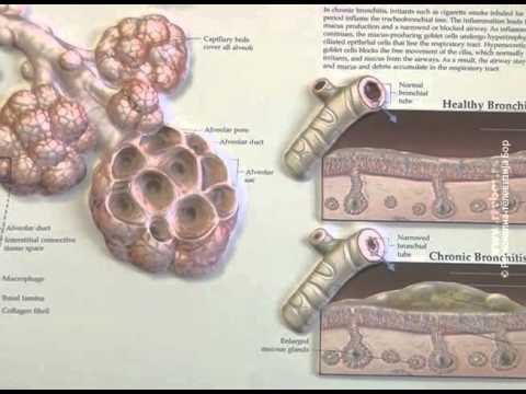 Opstruktivna bolest pluća, 18. novembar 2015. (RTV Bor)