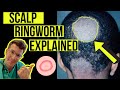Doctor explains Scalp Ringworm (Tinea Capitis) including causes, symptoms, treatment & more!