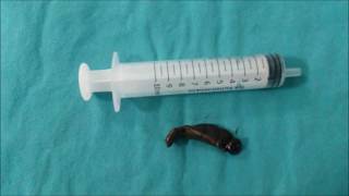 preview picture of video 'Hastanemizde bir hastanın gırtlağından Ameliyatla 12 cm boyutunda canlı sülük çıkartıldı.'