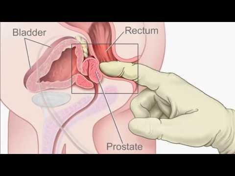 Ofloxacin mit xp Prostatitis Prostamol und Testosteron