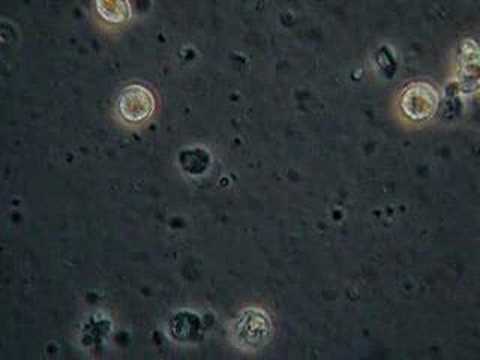 Behandlung von Duo sonirid Prostata-Adenom Präkanzerösen Prostatabehandlung