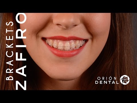 Brackets Zafiro – Ortodoncia en Madrid