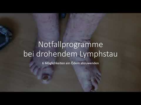 Möglichkeiten einen drohenden Lymphstau abzuwenden. Die 6 „Notfallprogramme“ die ein Ödem verhindern
