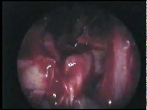 Papillary urothelial carcinoma patho outline