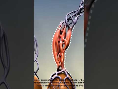 Varicocele embolization live case - Step 13 #nosurgery | Dr. Gaurav Gangwani