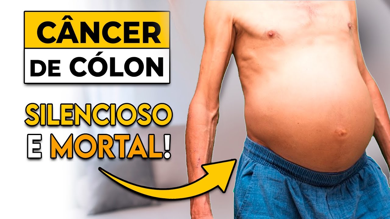 MUITO CUIDADO: Isto pode ser sinal de CÂNCER de COLON │ Sintomas de Câncer de Intestino