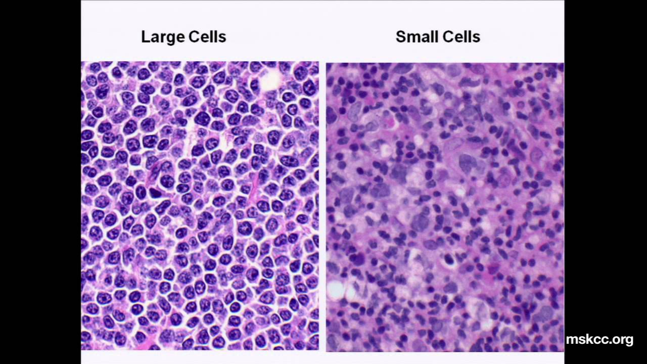 What You Need to Know about Non-Hodgkin's Lymphoma: Presentation