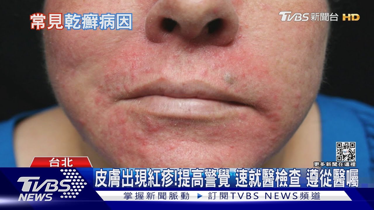 皮膚冒出「這個」皮屑掉滿地！輕忽它　醫師：延誤就醫關節疼痛變形