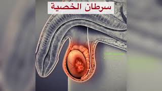 سرطان الخصية