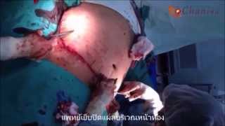 ผ่าตัดดึงหน้าท้องแก้ไขโรคอ้วนผิดปกติ ผ่าตัดดึงหน้าท้องแก้ไขโรคอ้วนผิดปกติ