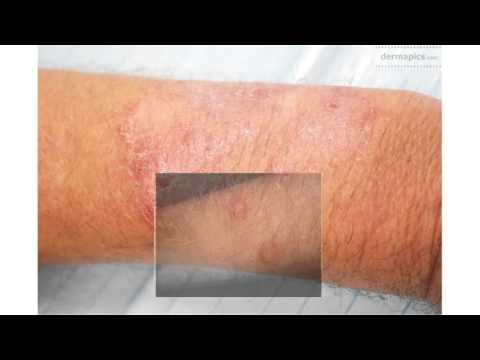Nail panahon halamang-singaw paggamot Kung paano upang mapahina ang iyong mga toenails na may gunting na panghalamanan fungus