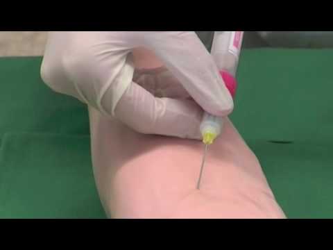 Diabetes mellitus, dass für Krankheit Diabetes Symptome bei älteren
