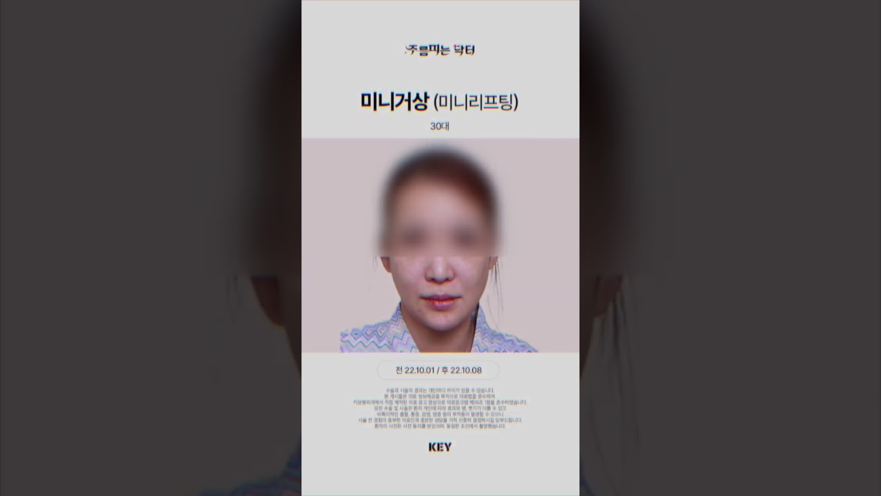 30대의 미니거상 미니리프팅 대구키성형외과