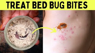 How to get rid of bed bug bites overnight fast in one day at home on your body   Remedy