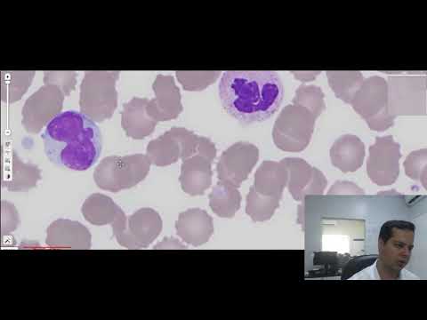 Contagem diferencial de leucócitos Correlações clínica dos leucócitos com resposta imunológica