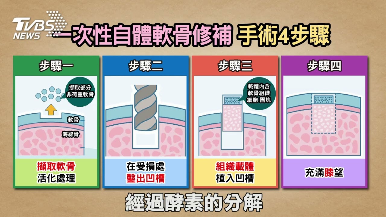 一次性自體軟骨修復術 關節炎治療方式打造新「膝」望