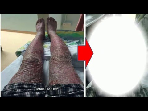 Als nejrodermit behandeln in kitaje Bei der Schuppenflechte auf dem Kopf kann man abfärben