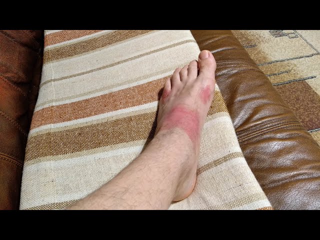 Лечение Ожогов 2 Степени После Вскрытия Волдырей В Домашних Условиях