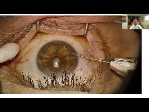 Lecture: MIGS and Evolving Non-traditional Glaucoma Treatment Options For Anterior Segment Surgeon
