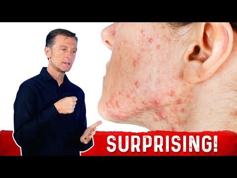 Why PROTEIN Does Not Help Hair Loss Brittle Nails and Collagen Loss – Dr Berg