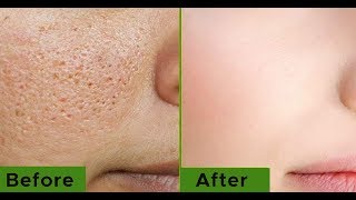 How to get rid of Large OPEN PORES permanently & Acne Scars NATURALLY AT HOME by using aloe Vera gel