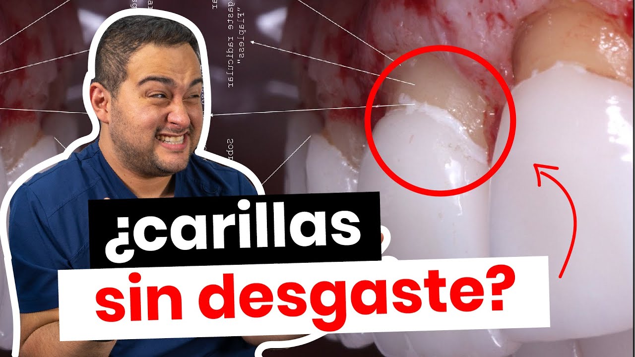 ¿CARILLAS DENTALES SIN DESGASTE ¡PUES NO! ¡CUIDADO con OFERTAS ENGAÑOSAS!