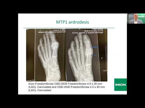 Inion Webinar: Tero Aaltonen - Clinical Experience of Inion FreedomPlate, Screw and Pin