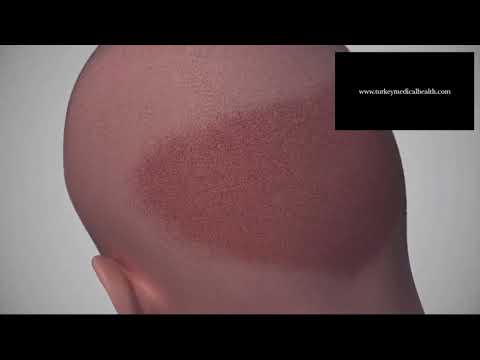 TMH Turkey Medical Health Hair Transplantation