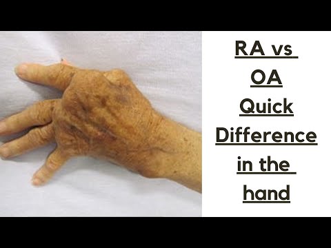 Rheumatoide Arthritis vs. Osteoarthritis – Ein kurzer Unterschied, den Sie an den Händen sehen kö...
