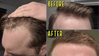 THE MOST SHOCKING HAIR LOSS REVERSAL I HAVE EVER SEEN WITHOUT A HAIR TRANSPLANT!