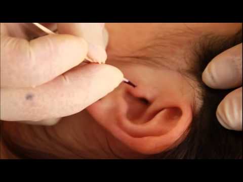 comment nettoyer piercing tragus