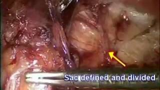 Laparoscopic Inguinal Hernia Meshplasty  (TEP) surgery