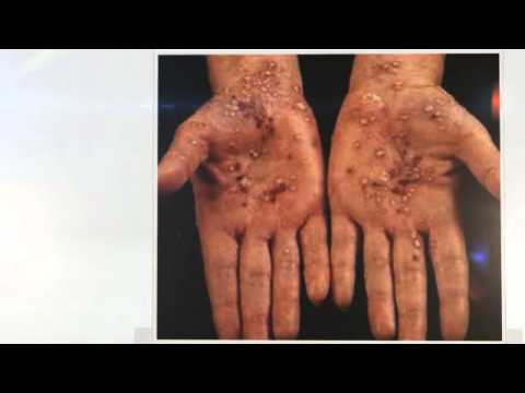 Siccome leczema della pelle comincia Targhe per neurodermatitis